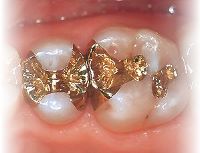 Zahnfüllungen aus Gold